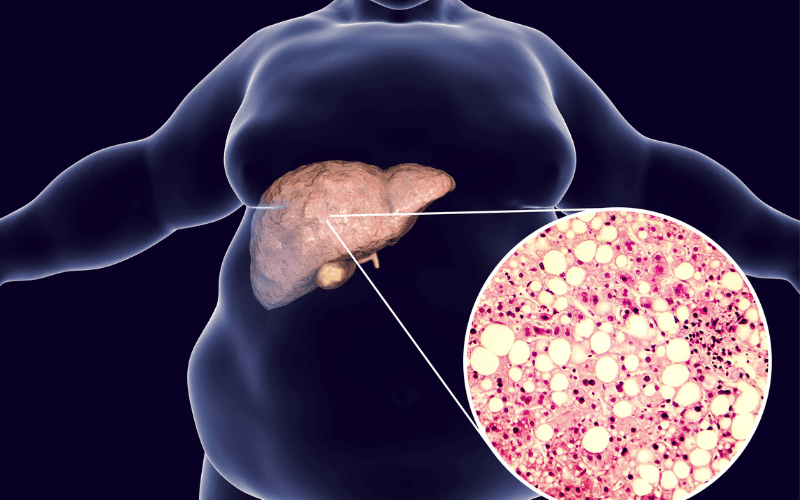 fibroscan liver test